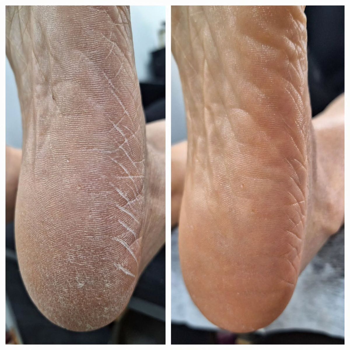 Mantar Tedavisi Uygulaması